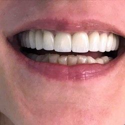 Navlake za zube primer 1