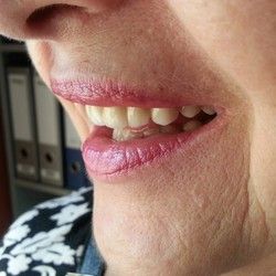 Navlake za zube primer 2