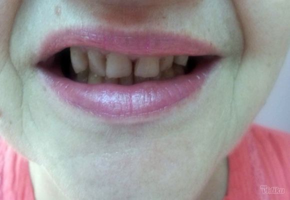 Navlake za zube primer 2
