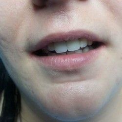 Navlake za zube primer 3
