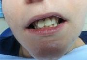 Navlake za zube primer 3
