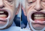 Pre i posle proteza za zube - Stomatološki centar Jovšić