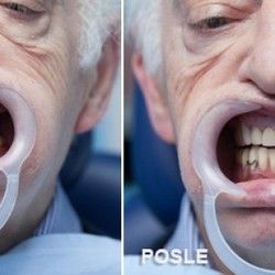 Pre i posle proteza za zube - Stomatološki centar Jovšić