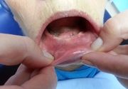 Stavljanje proteze za zube - Stomatološki centar Jovšić