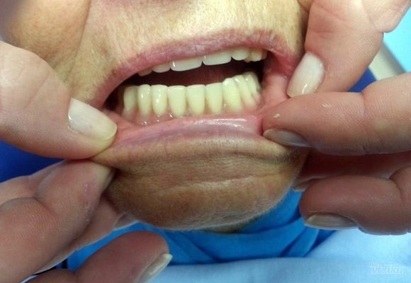 Stavljanje proteze za zube - Stomatološki centar Jovšić