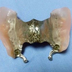 Lepljenje zubne proteze