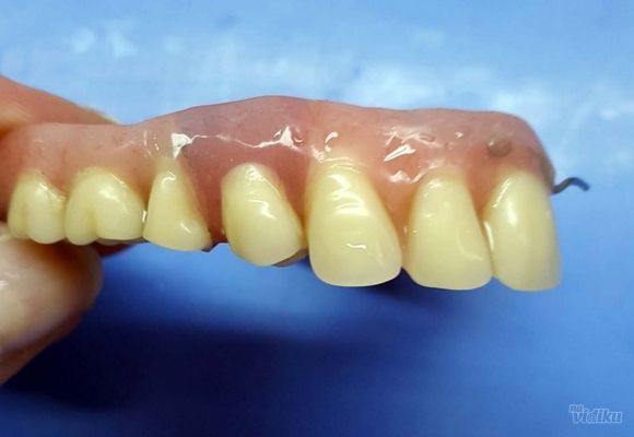 Dodatak zuba u protezi