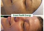 Tretman lica Green Peel Energy