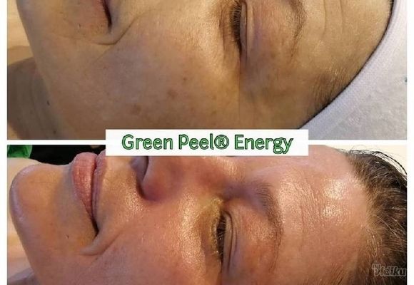 tretman-lica-green-peel-energy24894.jpg