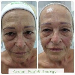Green Peel tretman lica