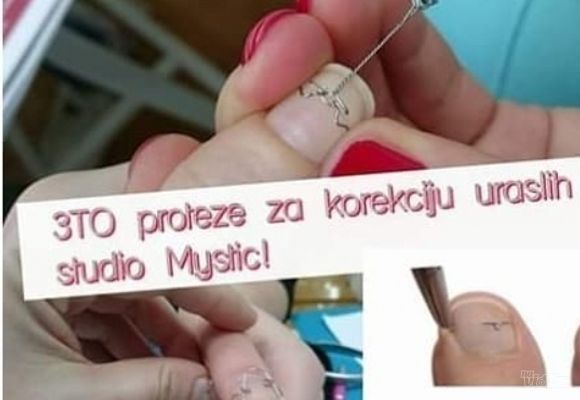 medicinski-pedikir-i-proteze-za-urasle-nokte34755.jpg