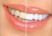 Gel metoda za beljenje zuba