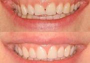 Recesija gingive Stomatoloska ordinacija US Dental Kragujevac