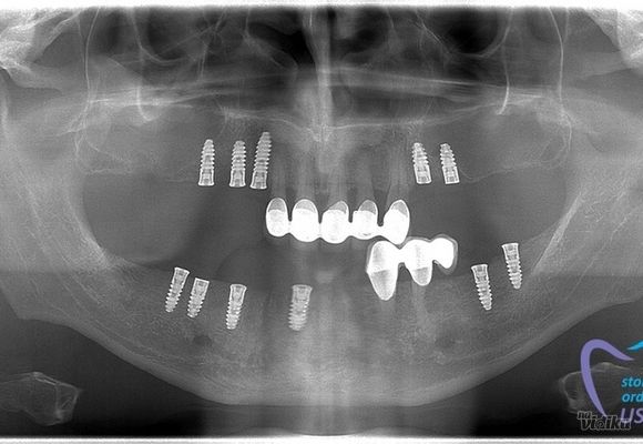Zubni implanti Kragujevac - Stomatoloska ordinacija US Dental Kragujevac