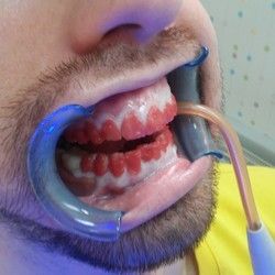 Izbeljivanje zuba Kragujevac - Stomatoloska ordinacija US Dental Kragujevac