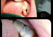Popravka zuba Karaburma