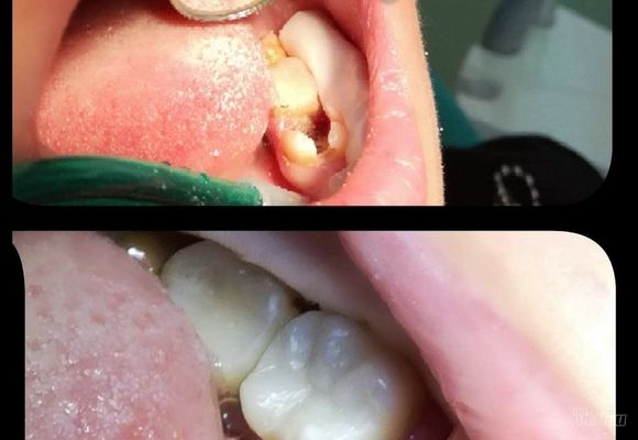 Popravka zuba Karaburma