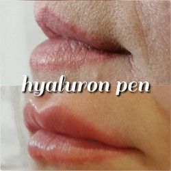 Hyaluron Pen