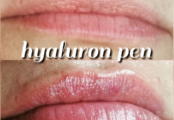 Hyaluron Pen
