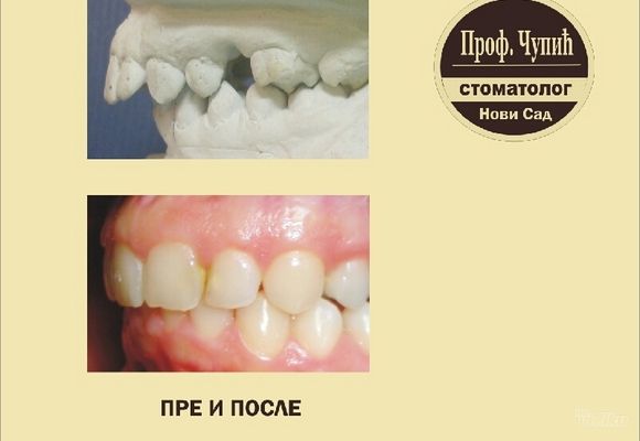 Ortodoncija pre i posle