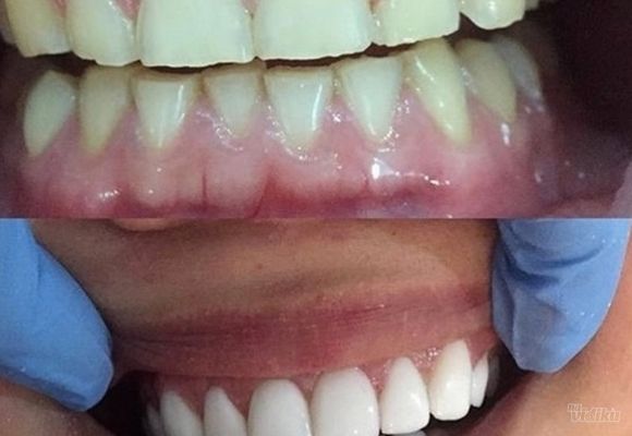 Put ka boljem zdravlju i lepšem izgledu zuba - Stomatološka ordinacija US Dental Kragujevac