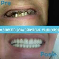 Zubne proteze Beograd