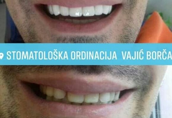 Povoljne krunice za zube Beograd