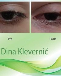 Uklanjanje papiloma