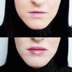 Povećanje usana - Prirodan izgled