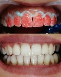 Ordinacijsko izbeljivanje zuba Kragujevac