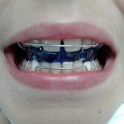Decije proteze za zube - Monoblok proteza za decu
