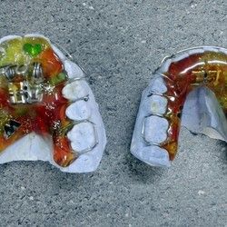 Decije proteze za zube - Twin block aparat za decu