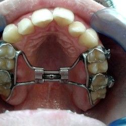 Decije proteze za zube - Aparat za brzo širenje nepčane suture (rpe)