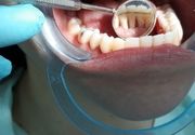 Decije fiksne proteze - Fiksni retainer za zube