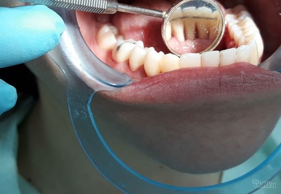 Decije fiksne proteze - Fiksni retainer za zube