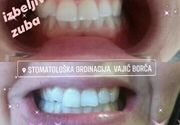 Najpovoljnije izbeljivje zuba Beograd