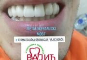 Krunice za zube Beograd