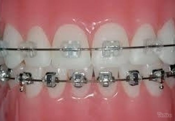 fiksna-proteza-cena-ortodontski-aparat-lingvalna-proteza-ortodoncija-153314.jpg