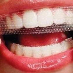 Folije za ispravljanje zuba