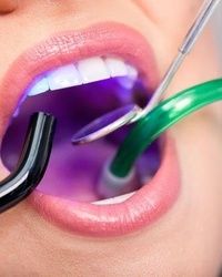 Plombiranje zuba lecenje korena kanala zuba