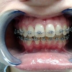 Decije proteze za zube