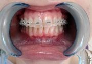 Decije proteze za zube Cukarica