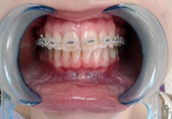 Decije proteze za zube Cukarica