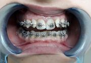 Decije proteze za zube Alegra Dent