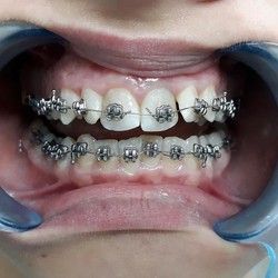 Decije proteze za zube Alegra Dent