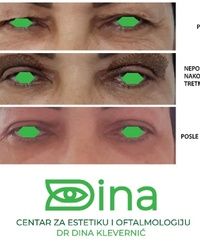 PODIZANJE KAPAKA BEZ OPERACIJE