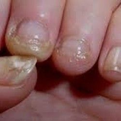 Lečenje homeopatijom gljivica na noktima