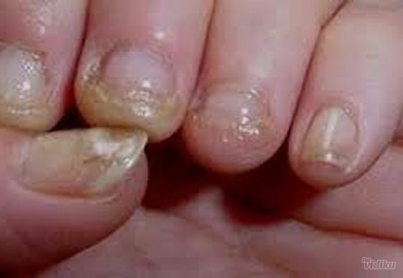 Lečenje homeopatijom gljivica na noktima