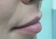 Povecanje i konturisanje usana