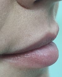 Povecanje i konturisanje usana